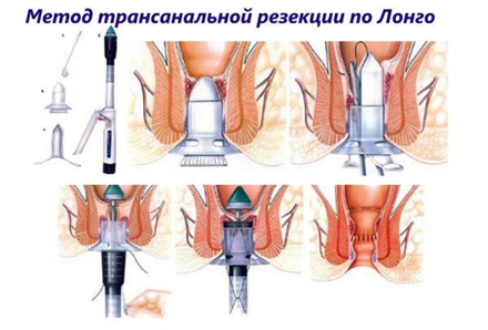 Операция Лонго